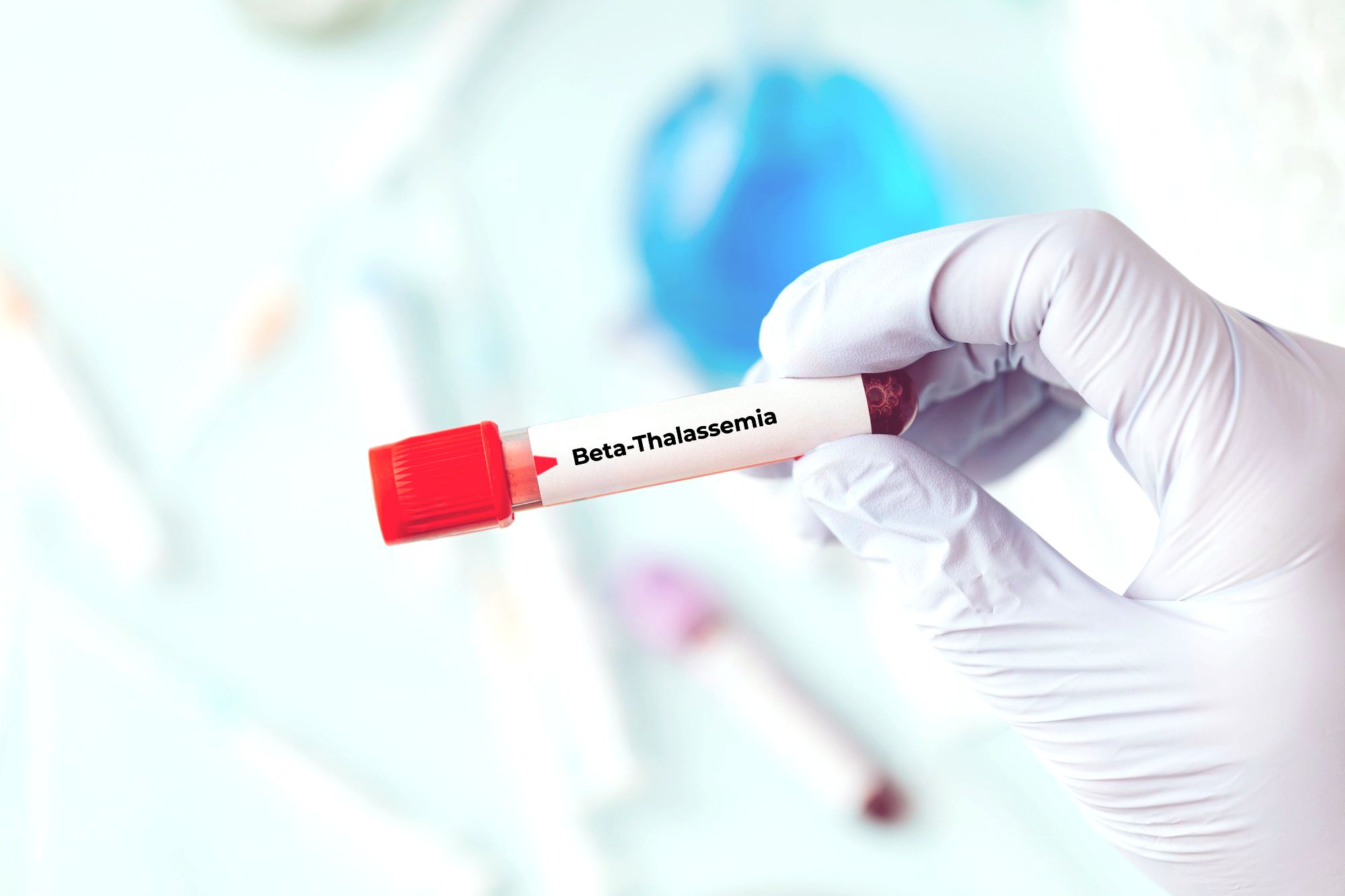 CRISPR: Novel hope for beta-thalassemia